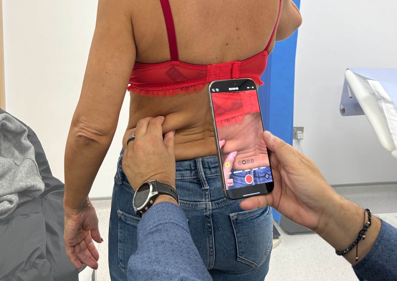 back fat which can be helped with vaser liposuction back fat which can be helped with vaser liposuction